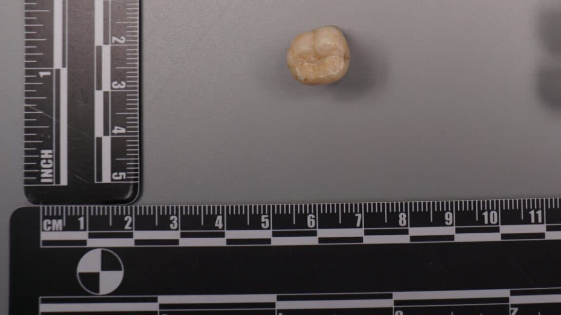 Ancient proteins in Homo erectus teeth reveal DNA link to modern humans via Denisovans