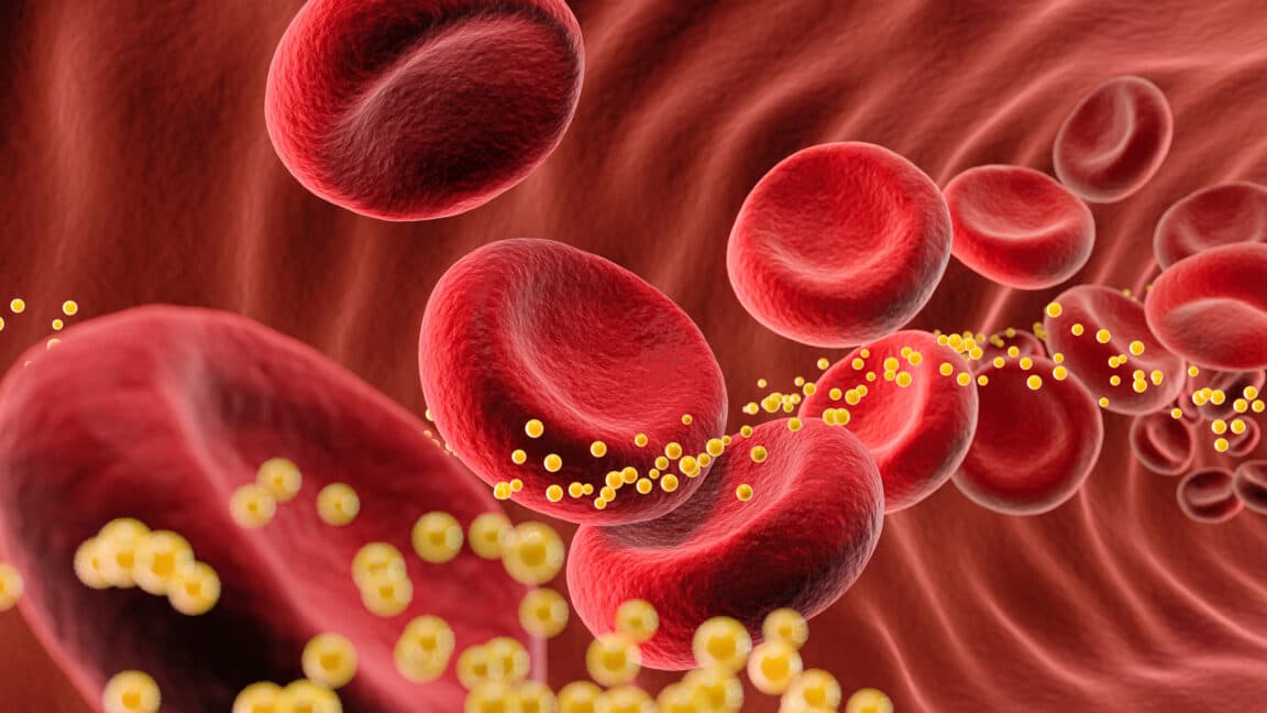 Gene-editing drug VERVE-102 cuts bad cholesterol 62% in early trial
