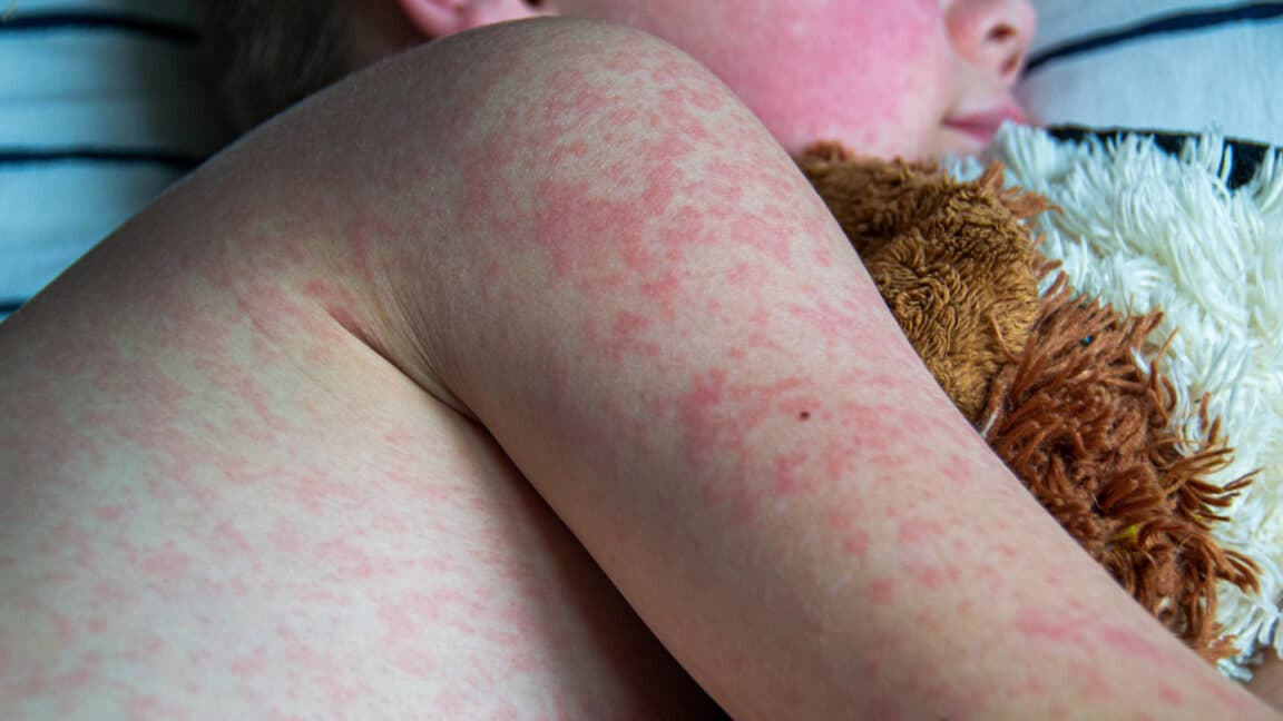 Texas measles outbreak analysis reveals 20% hospitalization rate, debunks 'just a rash' claims